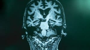 Unraveling Alzheimer's Disease: From Risk Factors to Prevention Strategies
