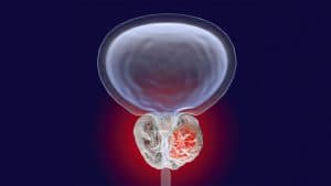 Advancing Prostate Cancer Care Through Research and Innovation